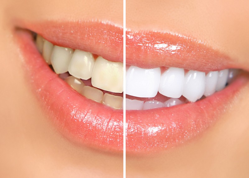 Teeth Whitening INSERT LOCATION